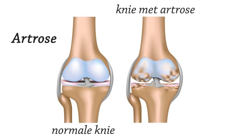Omgaan met artrose